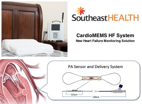 SoutheastHEALTH to Offer New Heart Failure Monitor